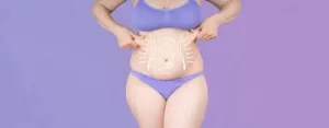 The Steps of a Tummy Tuck Procedure